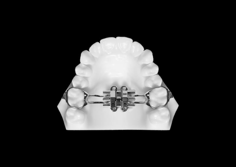 A dental model shows a MARPE palatal expander, offered by Elara Orthodontics in Richmond or Houston, TX.