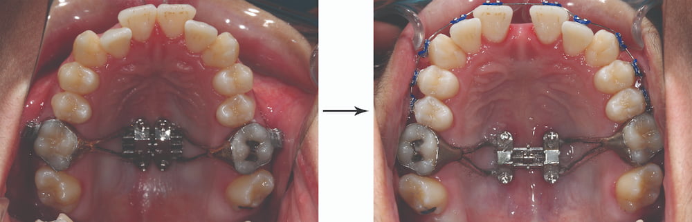 Before-and-after images of an MSE2 MARPE expander at Elara Orthodontics in Richmond or Houston, TX, showing dental arch changes.