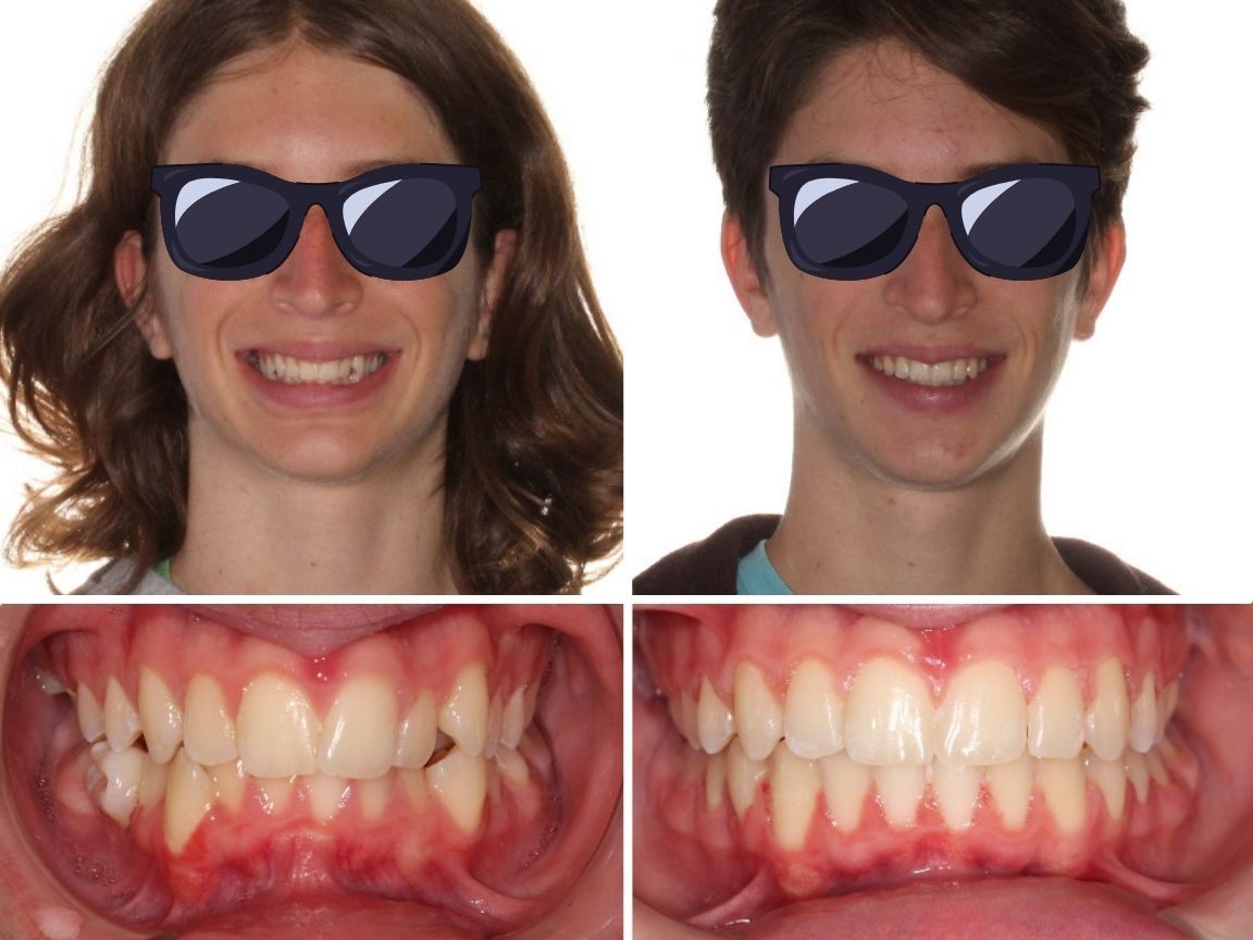 Before and after photos at Elara Orthodontics in Richmond, TX show improved dental alignment on a smiling person.