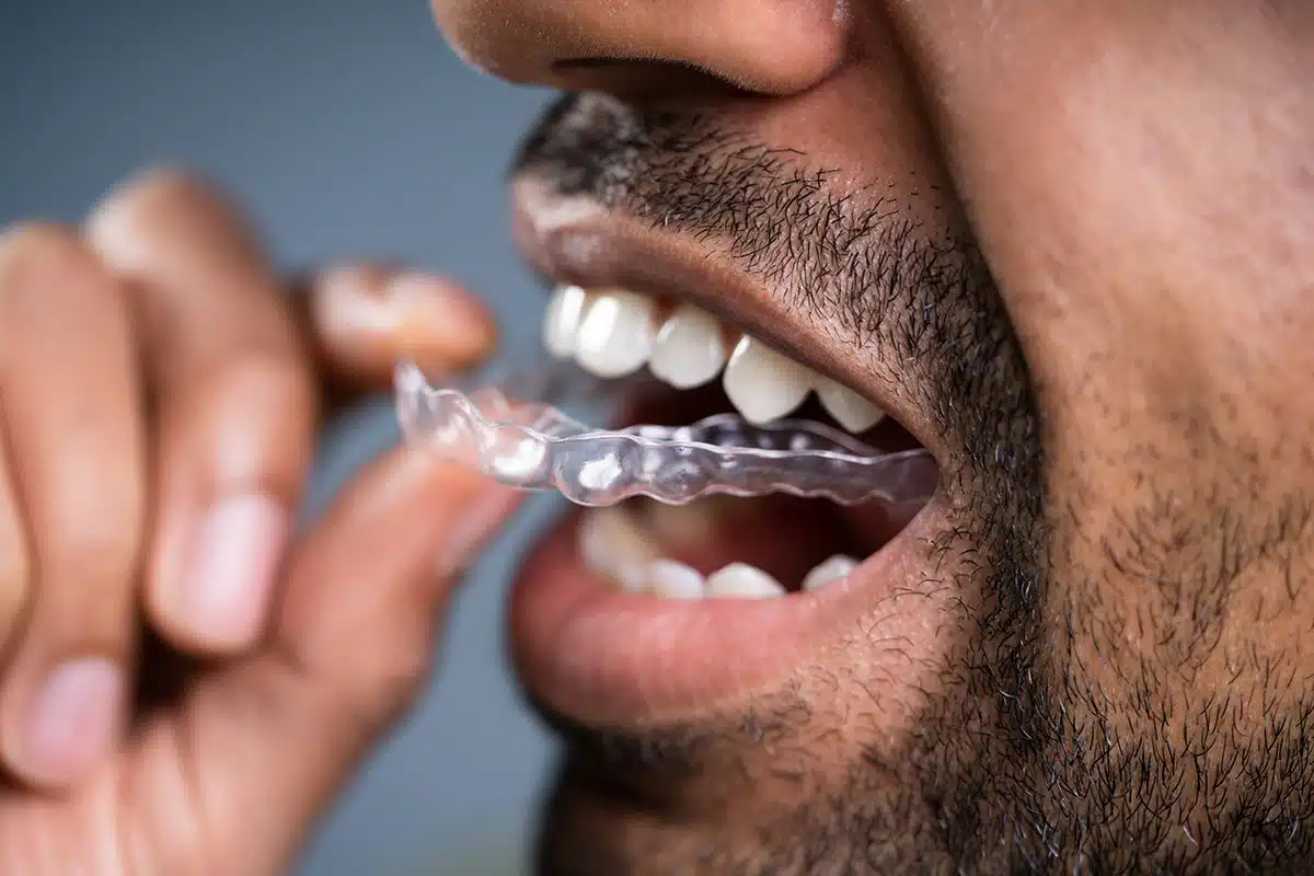 DIY Braces