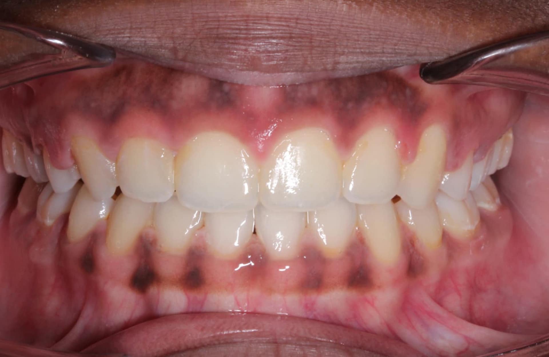 At Elara Orthodontics in Richmond, TX, close-up of teeth and gums shows dental crowding, pigmentation, and open bite.