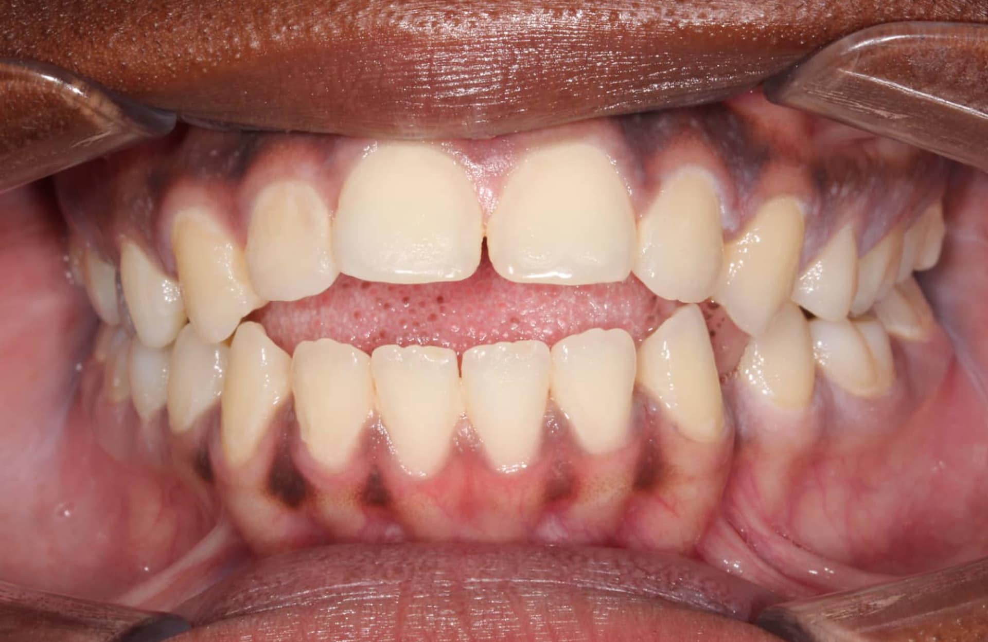 Before treatment at Elara Orthodontics in Richmond, TX: close-up of open bite, misaligned teeth, gums and lips retracted.