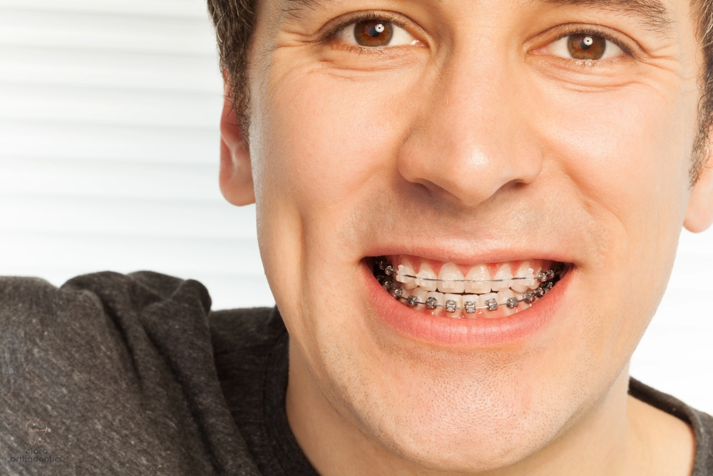 happy young man with metal braces - Overbite vs Underbite in Houston and Richmond, TX.