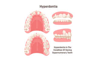 Hyperdontia