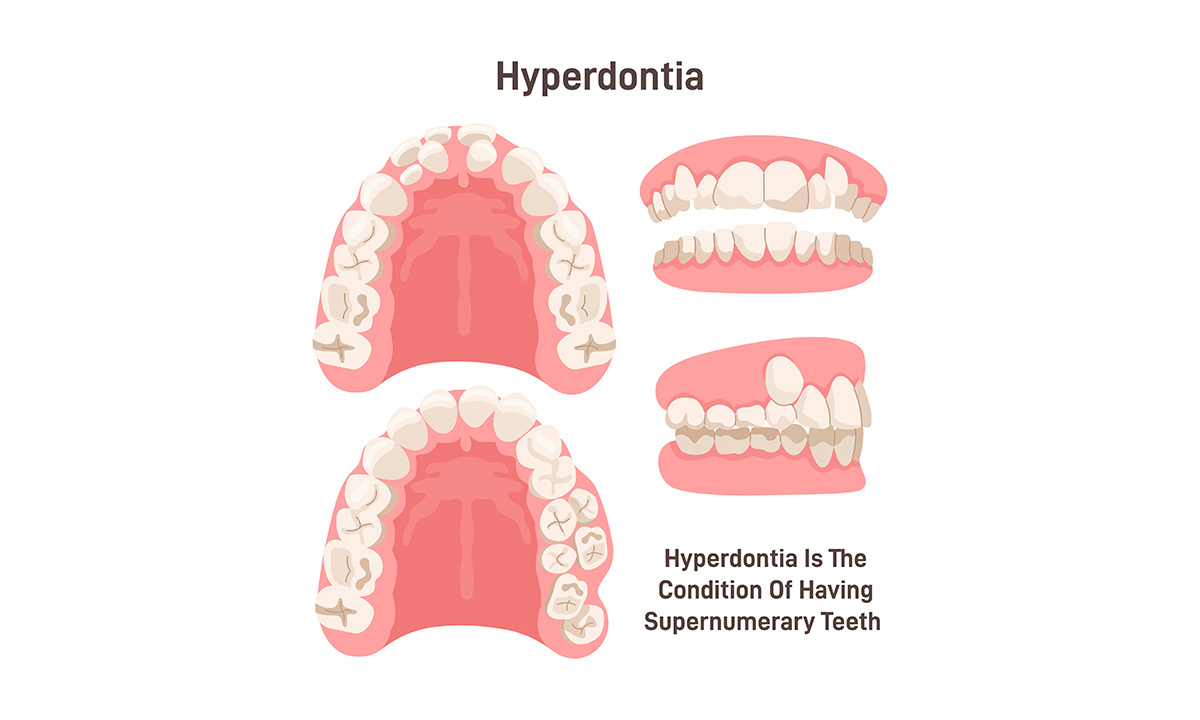 Hyperdontia