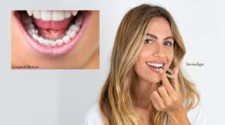 Lingual Braces Vs. Invisalign