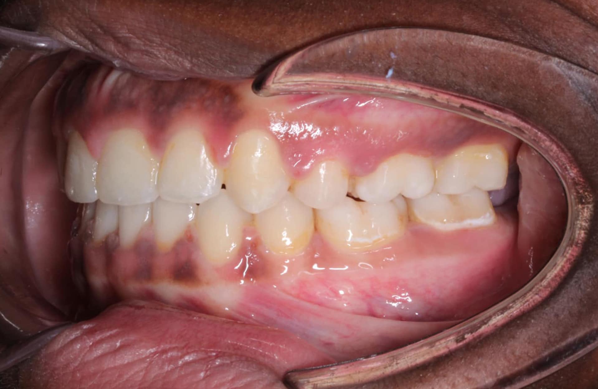 Teeth and gums shown with retractors exposing a side bite after Open Bite treatment at Elara Orthodontics in Richmond, TX.
