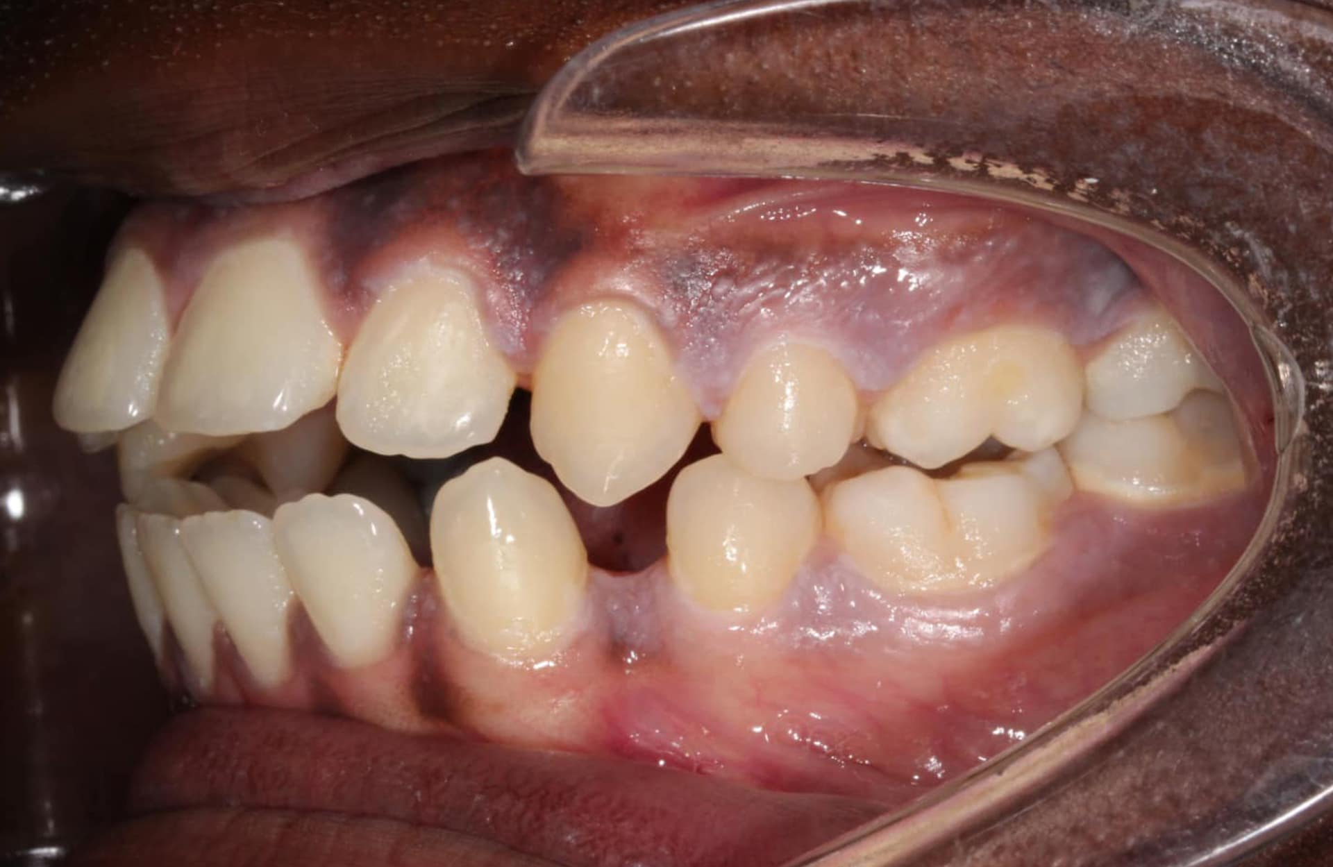 A patient at Elara Orthodontics in Richmond, TX shows an open bite with misaligned teeth and retractors before treatment.