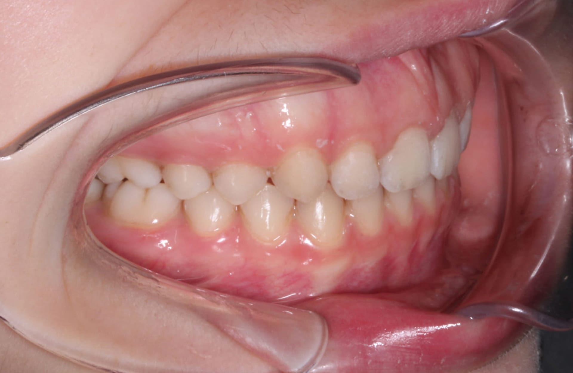 Healthy right-side teeth and gums after overjet treatment at Elara Orthodontics in Houston, TX, with retractor visible.