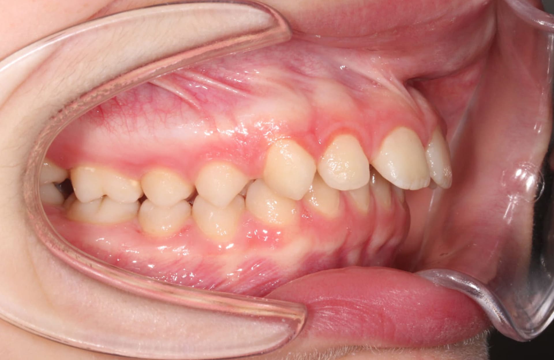 A close-up of an open mouth with severe overjet and misalignment, seen at Elara Orthodontics in Houston, TX.