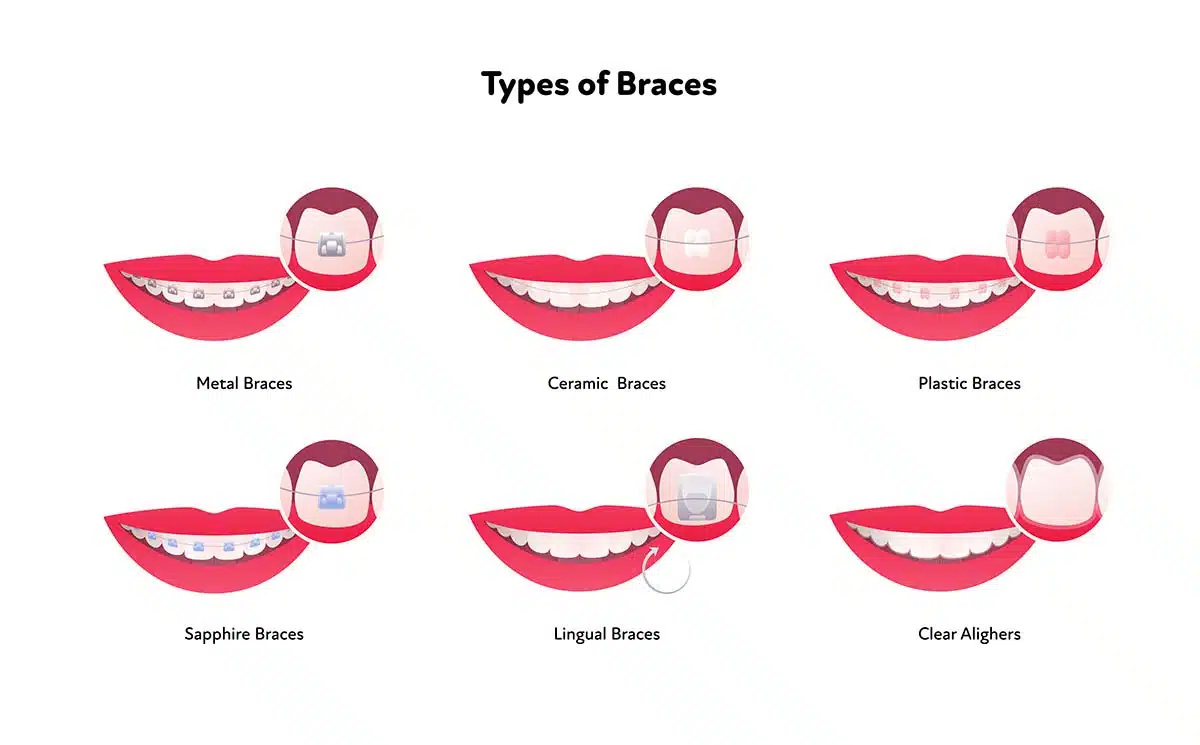 Types of Braces