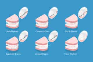 types of braces