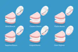 types of braces