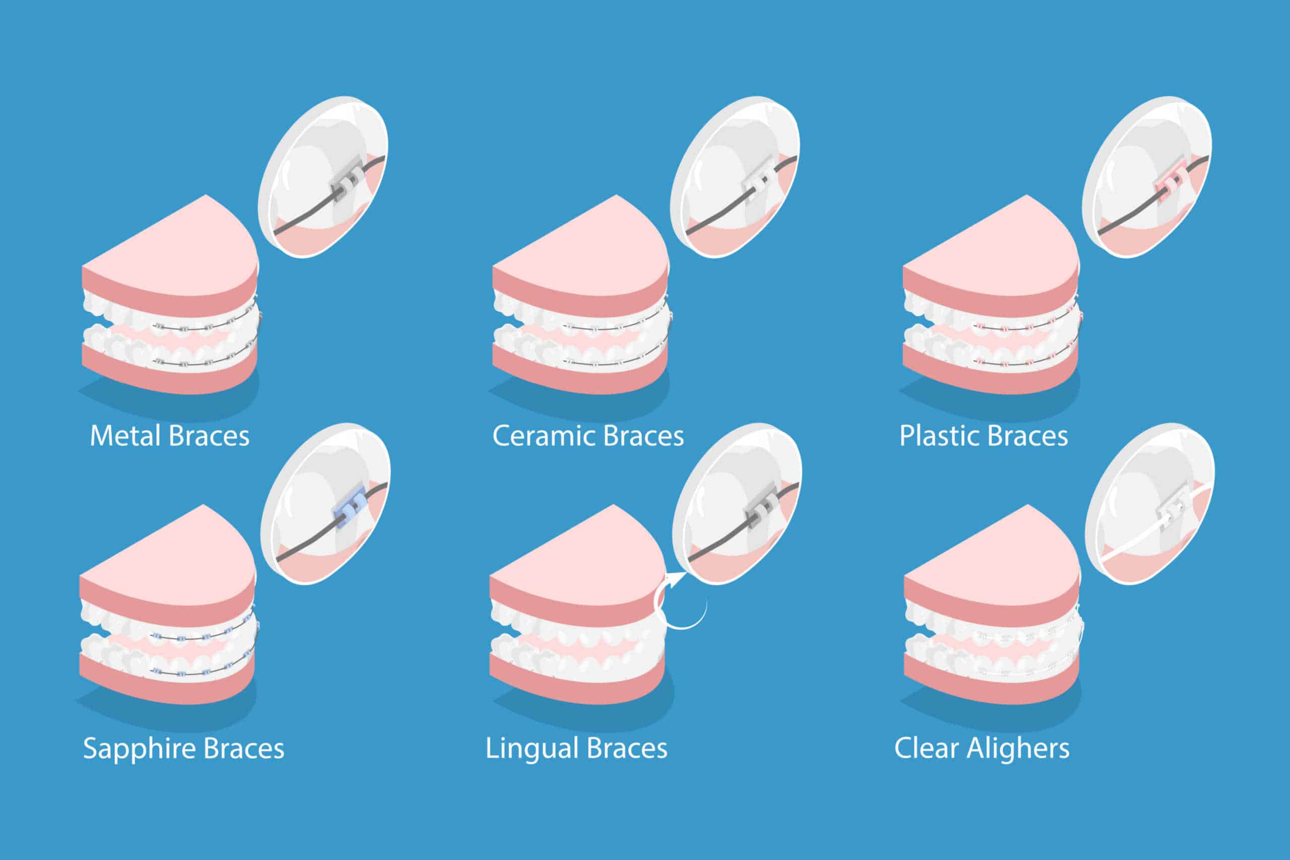 types of braces